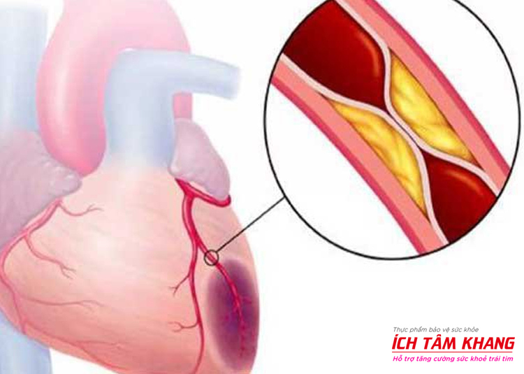 Hội chứng mạch vành cấp chiếm đến 50% nguyên nhân gây ra phù phổi cấp